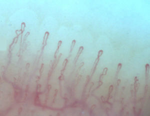 Nailfold videocapillaroscopy with normal pattern, with “comb-shaped” capillaries in each dermal papilla (200× magnification). Optilia Capillaroscope. Service of Capillaroscopy, Bolivarian University Clinic.