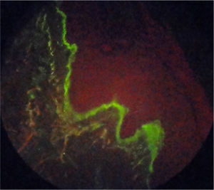 Immunofluorescence in positive IgM cutaneous biopsy in strong and continuous membrane pattern.