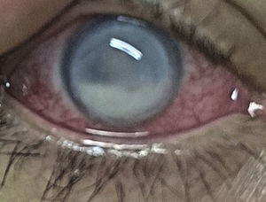 Initial manifestations: 360° limbal superficial vascularization, cornea with 360° peripheral melting, epithelial ulcer, severe generalized edema, fibrin hypopyon.