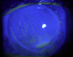 Post-treatment manifestations: recovering from the corneal epithelial ulcer.