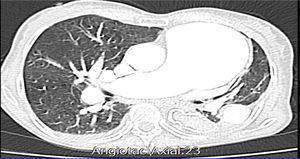 Axial view of chest CT-angiography.