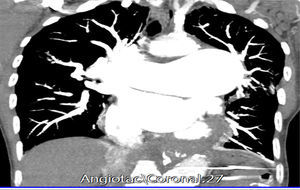 Coronal view of chest CT-angiography. Dilatation of the branches of the pulmonary artery which reaches a diameter of 73mm at the level of its trunk of exit. There is a big aneurysmal dilatation of the descending portion whose diameter in PA is 40mm with formation of a big mural thrombus and there is an associated hypodense linear image that corresponds to a dissection of the pulmonary artery.