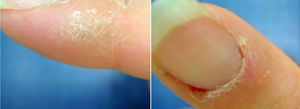 Scaly lesions on the lateral and distal part of the fingers and presence of cuticulitis.
