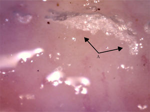Capillaroscopy of the nail bed. A: unidentified material similar to glue. The unidentified glue-like material affected the quality of the image by causing the reflection of light, and for this reason the images contain light reflections and dispersion.