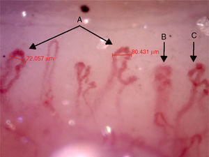 Capillaroscopy of the nail bed. A: giant capillaries; B: tortuous capillary; C: criss-crossed capillaries. The unidentified glue-like material affected the quality of the image by causing the reflection of light, and for this reason the images contain light reflections and dispersion.