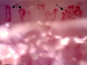 Capillaroscopy of the nail bed. A: dilated capillaries; B: arborified capillary and loss of the capillary structure. The unidentified glue-like material affected the quality of the image by causing the reflection of light, and for this reason the images contain light reflections and dispersion.