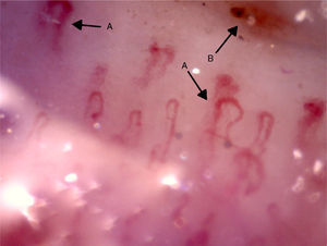 Capillaroscopy of the periungual bed. A: dilated capillaries: B: microhemorrhages. The unidentified glue-like material affected the quality of the image by causing the reflection of light, and for this reason the images contain light reflections and dispersion.