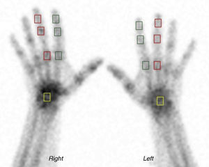 Areas of interest. Bone scintigraphy of the hands; in green squares, areas of interest on the interphalangeal and metacarpophalangeal joints of the second finger; in red squares, areas of interest on the interphalangeal and metacarpophalangeal joints of the third finger; in yellow squares, areas of interest on the carpus.
