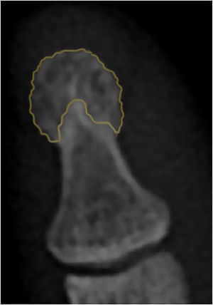 Usual radiographic appearance of the tuft. The orange color demarcates the area corresponding to the DPTH. Denote the typical lanceolated appearance (in lobes) of the cortical.
