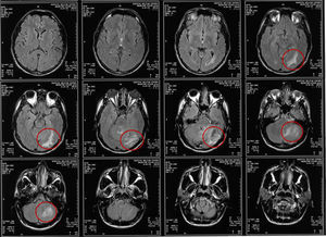 Nuclear magnetic resonance of central nervous system report. It is noted an image hyperintensity with evidence of the presence of perilesional edema located at the infratentorial and the left parietal occipital levels.