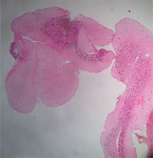 Pathology report, April 20, 2011. Microscopic description: Material represented by free fragments of cerebellar cortex. Three layers on meneinges are identified. There on the subarachnoid space arterial wall fragments without transition to venous wall. In the material examined are not observed nonneoplastic or arteriovenous malformation or metastatic lesion.