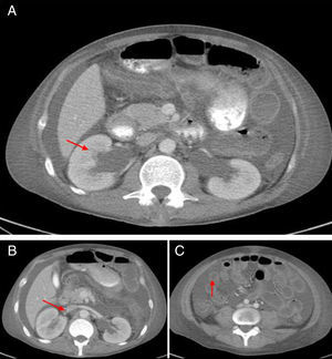 Abdominal CT scan with contrast. A) It can be seen hepatomegaly and splenomegaly, ascites, bilateral mild hydronephrosis. B) Image suggestive of thrombosis of the right renal vein. C) Signs of interstitial vasculitis (target sign suggestive of intestinal edema).