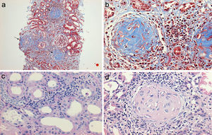 (a) Renal biopsy showing a panoramic view (10×) of a cylinder of tissue with sclerosed glomeruli (Masson's trichrome), in which the collagen fibers that replace the normal glomerular tissue are stained with blue (b) with an extensive mononuclear and polymorphonuclear periglomerular and interstitial peritubular inflammatory reaction that ends forming a fibrocellular crescent (c) and (d).