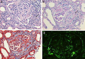 (a) Glomerulus with severe interstitial and periglomerular inflammatory infiltrate (hematoxylin-eosin staining) that causes fibrin transudate forming cellular crescents that evolve to fibrocellular (b), which over few weeks end up as fibrous crescents with extensive accompanying glomerular sclerosis (c). Immunofluorescence of C3c with absence of an intense fluorescent granular pattern as in autoimmune glomerulopathies is shown, hence the term pauci-immune (d).