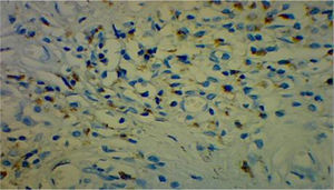 Immunohistochemistry: staining for IgG4, showing 50 plasma cells (+) for IgG4/high-power field.