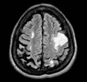 Cortical-subcortical lesion located in the left frontal parietal lobe with decrease of the local cerebral sulci in FLAIR sequence, showing important restriction in diffusion sequence, it does not uptake contrast media. Multiple small infarcts of the white matter.