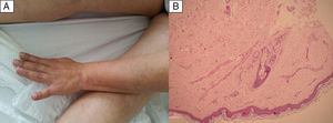 Photo of the arm and thighs showing reticular shaped violaceous erythema, irregular livedo racemosa cutaneous lesions (A). Skin biopsy of livedo racemosa: mild superficial perivascular lymphocytic dermatitis, with mild dilation of the capillaries and moderate extravasation of the red blood cells. Fibrinoid necrosis is not found in the blood vessels. Suggestive of occlusive vascular pathology (B).