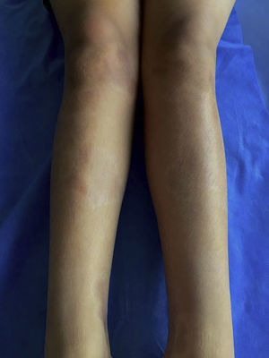 Chronic lesions of scleroderma in the lower limbs.