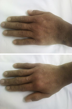 Photograph of the hands. Bilateral synovitis of the 2nd and 3rd metacarpophalangeal and the 2nd to 5th proximal interphalangeal joints is observed.