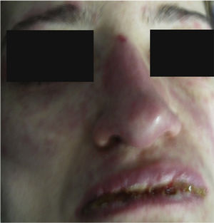 Lips with erosions covered by yelowish crusts. Face skin with erythemadoedematous plaques.