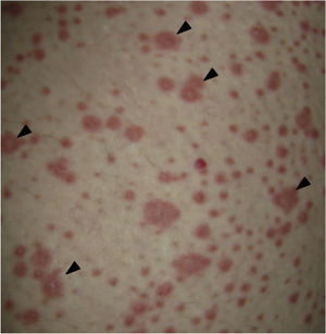 Skin of the right thigh with erythematoedematous target papules (triangles).