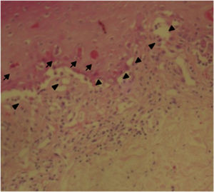Skin biopsy: epidermis with extensive damage of vacuolar interface (triangles), associated with dyskeratocytes (small arrows) and subepidermal vesiculation.