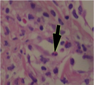 Papillary dermis of edematous appearance with lymphocytary perivascular infiltrate with some eosinophils (large arrow).