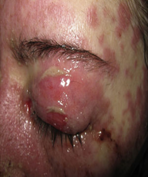 Skin of the left eyelid with erythematoedematous plaques and erosive lesions.