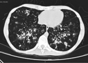 HRCT. Pulmonary emphysema, cylindrical bronchiectasis toward the lower lobes with wall thickening, mixed patchy infiltrates predominantly in the right lung, reticulomicronodular infiltrates resembling a budding tree.