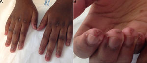 Dorsal aspect of the patient's hands showing diffuse edema to middle phalanges, hypopigmented macules of atrophic appearance in metacarpophalangeal and proximal interphalangeal joints and periungal erythema (A). On the palmar side there are scarring lesions on the finger pads (B).