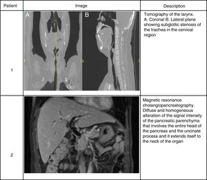 Imaging findings in 2 patients with IgG4-related disease. Patient 1. Tomography of the larynx. (A) Coronal plane. (B) Lateral plane showing subglottic stenosis of the trachea in the cervical region. Patient 2. Magnetic resonance cholangiopancreatography. Diffuse and homogeneous alteration of the signal intensity of the pancreatic parenchyma that involves the entire head of the pancreas and the uncinate process and it extends itself to the neck of the organ.