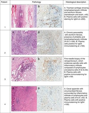 Pathological findings in 4 patients with IgG4-related disease. Patient 1. (A) Tracheal cartilage showing lymphoplasmacytic infiltrate and storiform fibrosis (hematoxylin and eosin, ×40). (B) Plasma cells with positive staining for IgG4, ×200). Patient 2. (A) Chronic pancreatitis with storiform fibrosis, presence of phlebitis and lymphoplasmacytic infiltrate (hematoxylin and eosin, ×100). (B) Plasma cells positive for IgG4 immunostaining (×100). Patient 3. (A) Fine-needle biopsy of the retroperitoneum, which evidences spindle cells with inflammatory infiltrate composed of lymphocytes and plasma cells (hematoxylin and eosin, ×40). (B) Plasma cells with positive immunostaining for IgG4 (×100). Patient 4. (A) Cecal appendix with circumscribed fibrosis surrounded by inflammatory infiltrate of lymphocytes and plasma cells (hematoxylin and eosin, ×40). (B) Plasma cells with positive immunostaining for IgG4 (×100).