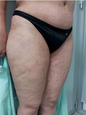 Marked induration in lower hemiabdomen and livedo reticularis in thighs.