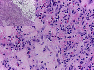 Thickening of the fascia, fibrin deposit, and inflammatory infiltrate composed of lymphocytes and eosinophils.