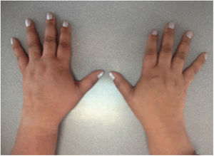 Photo of the patient's hands showing evidence of synovitis of the proximal interphalangeal joints, metacarpophalangeal joints and wrists.
