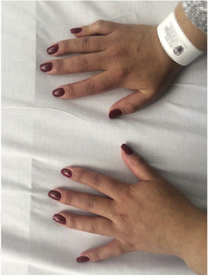 Photo of the patient's hands showing evidence of synovitis of the proximal interphalangeal joints, metacarpophalangeal joints and left wrist.