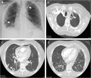 Pulmonary nodules and interstitial lung involvement. (A) PA chest X-ray with cavitations in the left upper lobe and the right lower lobe. (B) Cavitary mass in the left upper lobe. (C) Cavitating nodule in the right lower lobe. (D) Left pleural effusion of free appearance.
