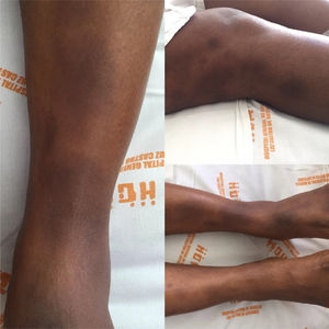 Multiple erythematous nodules in lower limbs which tend to coalesce.