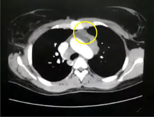 Solid lesion in the anterior mediastinum in relation to conglomerate of adenopathies.