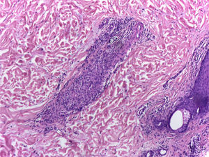 There is a great inflammatory process of septal localization in subcutaneous cellular tissue, characterized by the accumulation of lymphocytes, plasma cells and multinucleated giant cells, as well as few neutrophil polymorphonuclear cells.