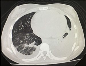 Simple chest tomography with evidence of left pleural effusion associated with ipsilateral compressive atelectasis and parenchymal bands in the right base.