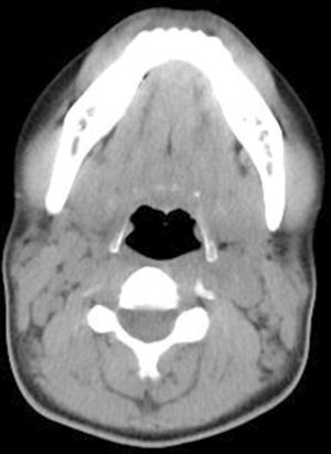 Simple neck CT: showing reactive lymphadenopathies localized bilaterally in segments I and II.