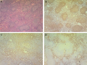 Lymph node biopsy. A. Hematoxylin and eosin stain: small necrotic foci and nodal and interfollicular hyperplasia with mononuclear cells showing mild atypia, intermixed with neutrophils and histiocytic cells. B–D. Immunohistochemistry: CD20 positive staining showing normal distribution lymphocytes, with evidence of hyperplasia (B). CD68 positive staining (C) and CD163 (D) of mostly interfollicular histiocytic cells. The cell proliferation rate measured by Ki67 is normal.