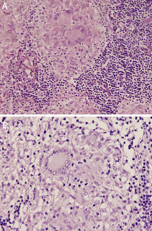 Mediastinal lymph nodes histology. (A) Shows non-caseating granulomas (H–E, 5×). (B) Magnification of a sarcoid granuloma with eosinophilic epithelioid cells and multinucleated giant cells surrounded by lymphocytes.