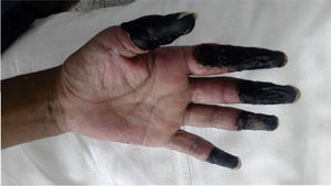 Ischemic–necrotic lesions in the distal zone of the 4 fingers of the left hand in a patient with cocaine/levamisole syndrome.