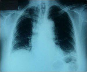 Chest radiograph showing reticular interstitial opacities distributed in the lower lobes and subpleural.