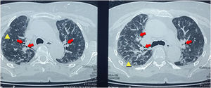 Chest CT-scan showing centrilobular nodules distributed in the upper lobes, associated with ground-glass areas (yellow triangle), and interlobular thickening with traction bronchiectasis (red arrows).