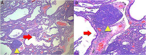 (A) A biopsy of the lung where there are lesions with a pattern of usual interstitial pneumonia. Irregular advanced lesions with the presence of a remarkable formation of cysts (red arrow) and lymphoid follicles in patches (yellow triangle). 4× magnification. (B) More details with 10× magnification. Hematoxylin and eosin staining.