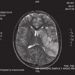 MRI in phase T2, with hyperintense lesion involving the left temporal anterior pole, the insula and the temporal lip of the ipsilateral operculum.
