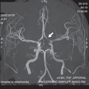 Irregularity of the wall and loss of the signal of the left internal carotid artery with extension to the emergence of the ipsilateral anterior and middle cerebral arteries (white arrow).